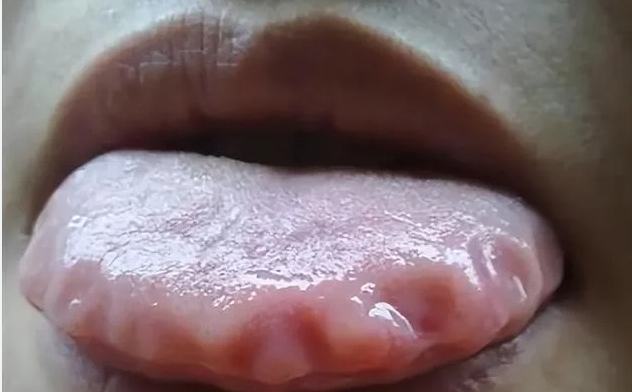 發現舌頭齒痕後該怎麼辦? 發現舌頭齒痕後該怎麼辦?