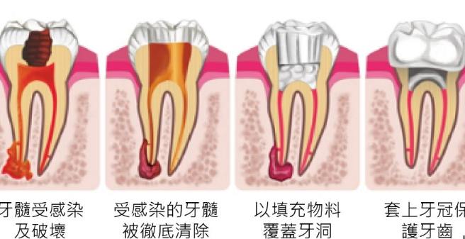 牙髓病症狀 牙髓病症狀