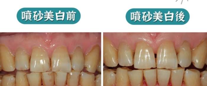 牙齒噴砂價格 牙齒噴砂價格