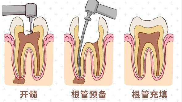 急性牙髓炎症狀 急性牙髓炎症狀
