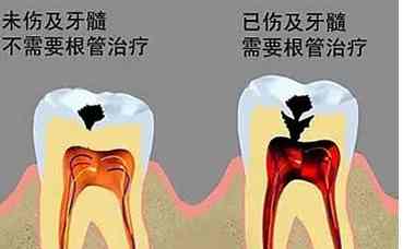 急性牙髓炎治療 急性牙髓炎治療