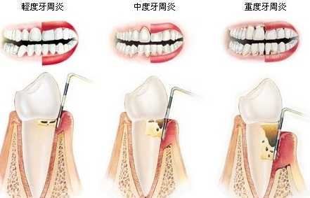 牙周炎介紹 牙周炎介紹