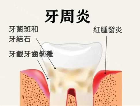 牙周炎抗生素 牙周炎抗生素