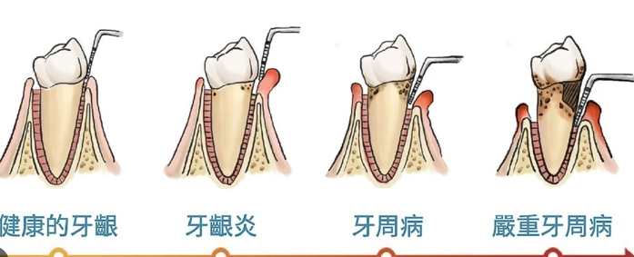 牙齦炎原因 牙齦炎原因