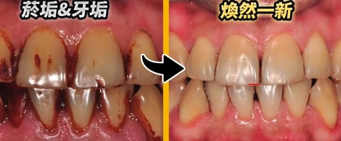 牙齒噴砂處理 牙齒噴砂處理
