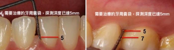 牙周囊袋深度分級 牙周囊袋深度分級