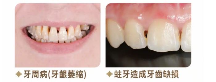 牙縫大矯正