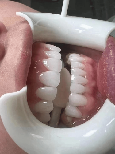 牙齒美白副作用 牙齒美白副作用