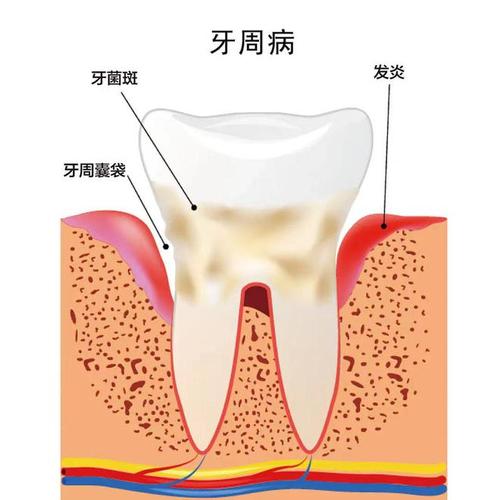 牙周病症狀治療 牙周病症狀治療