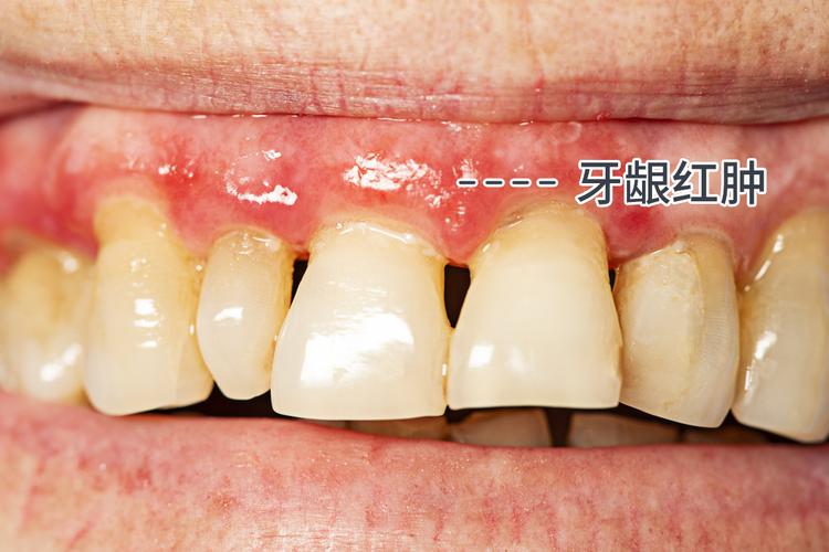 牙周病初期:如何及早發現並有效治療? 牙周病初期:如何及早發現並有效治療?